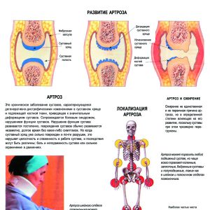 Плакат заболевания суставов человека